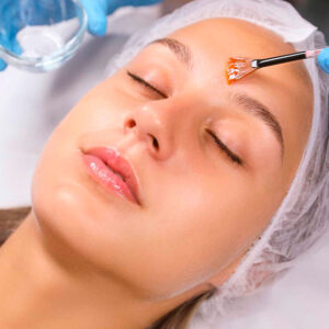 Peelings Quimicos