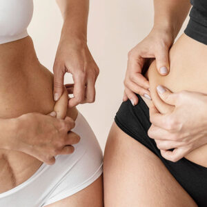 Mesoterapia corporal para celulitis y flacidez