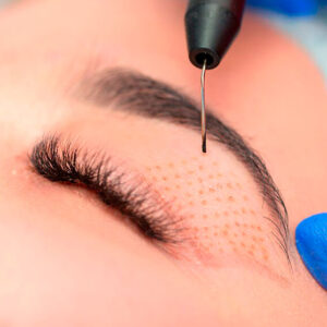 Plasmapen / Fibroblast