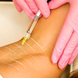 Tratamiento de Hiperhidrosis (Sudoración Excesiva) con Toxina Botulínica