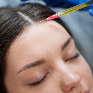 Tratamiento con microagujas para la caída capilar