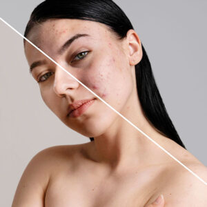 Tratamiento de Acné y Cicatrices Post Acné