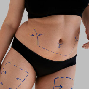 Tratamiento de Adiposidad Localizada